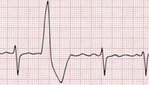 Defibrillazione arresto cardiaco